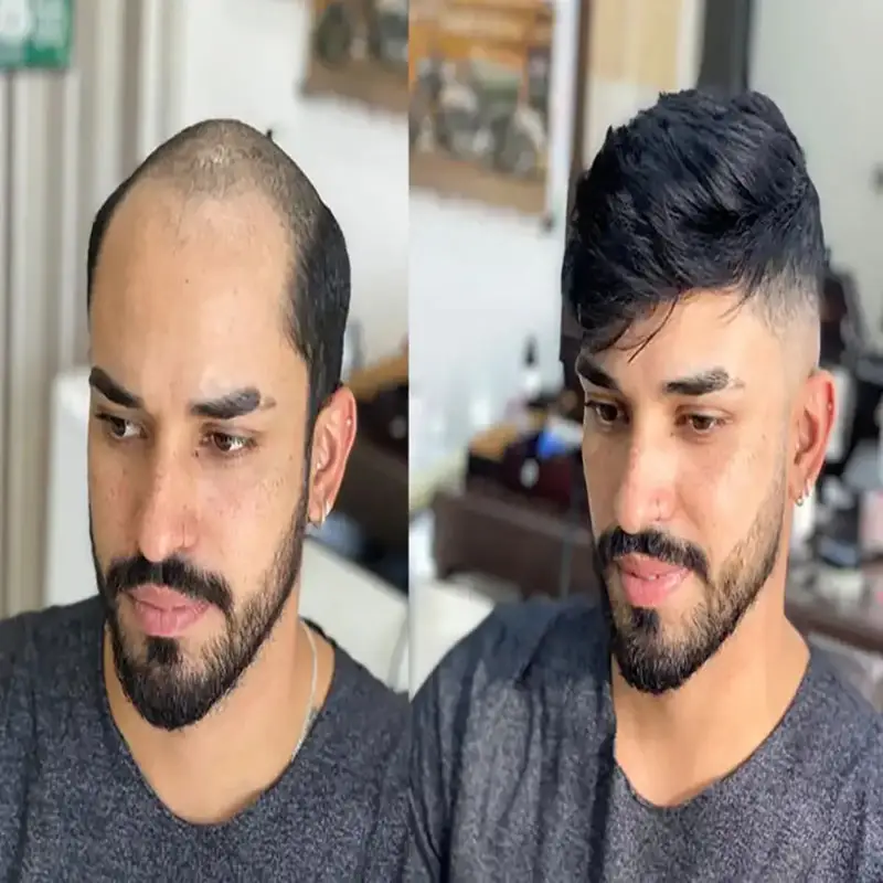 دوره آموزش ترمیم مو مردانه 5 دوره اموزش ترمیم مو مردانه